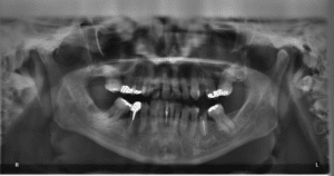 Dental Xray