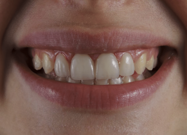 What Causes Tooth Discoloration and Different Types of Dental Stains