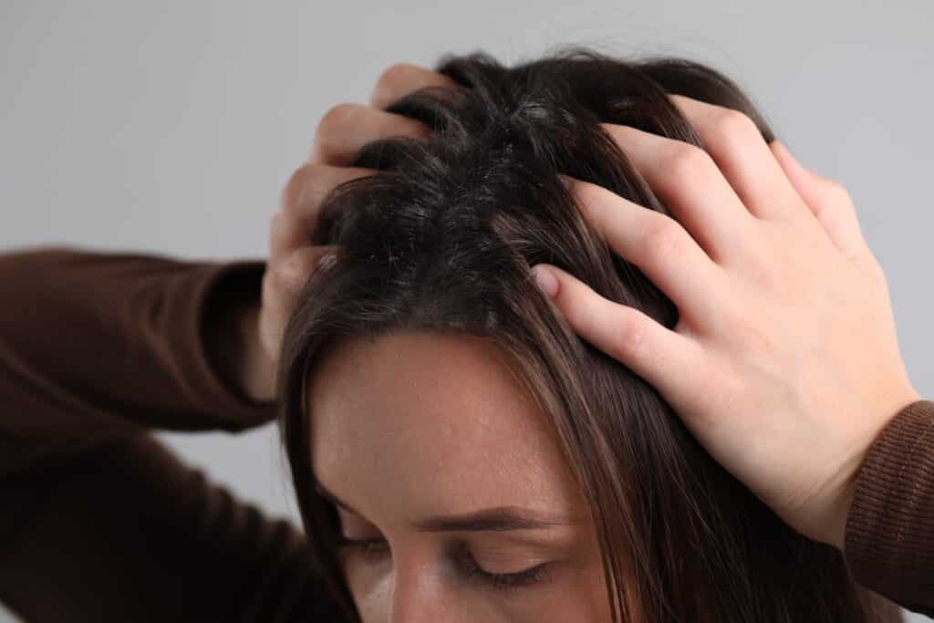 Scalp Psoriasis, Hair Shedding and What a Shampoo Can Realistically Do